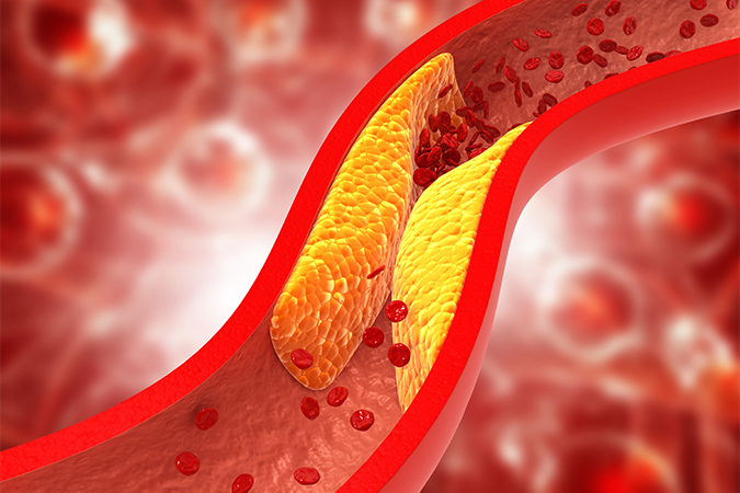 コレステロール Cholesterol 語源由来辞典